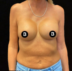 Breast Augmentation Before and After Pictures in Buffalo, NY