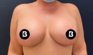 Breast Augmentation Before and After Pictures in Buffalo, NY