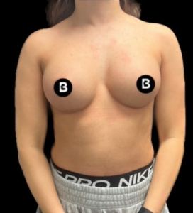 Breast Augmentation Before and After Pictures in Buffalo, NY