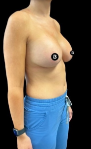 Breast Augmentation Before and After Pictures in Buffalo, NY