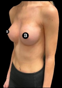 Breast Augmentation Before and After Pictures in Buffalo, NY