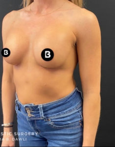 Breast Augmentation Before and After Pictures in Buffalo, NY