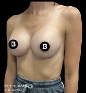Breast Augmentation Before and After Pictures in Buffalo, NY