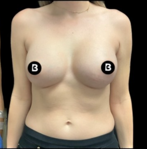 Breast Augmentation Before and After Pictures in Buffalo, NY