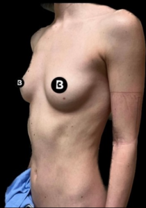 Breast Augmentation Before and After Pictures in Buffalo, NY