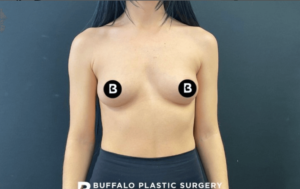 Breast Augmentation Before and After Pictures in Buffalo, NY