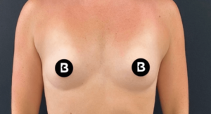 Breast Augmentation Before and After Pictures in Buffalo, NY