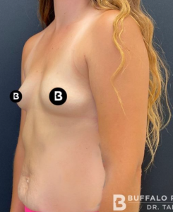 Breast Augmentation Before and After Pictures in Buffalo, NY
