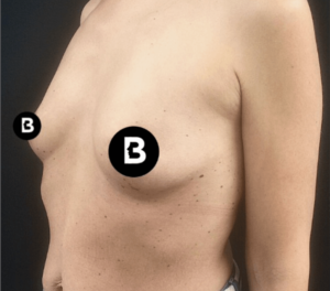 Breast Augmentation Before and After Pictures in Buffalo, NY