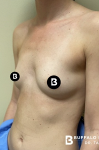 Breast Augmentation Before and After Pictures in Buffalo, NY