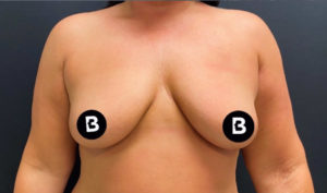 Breast Augmentation Before and After Pictures in Buffalo, NY