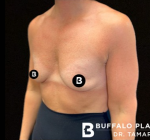 Breast Augmentation Before and After Pictures in Buffalo, NY