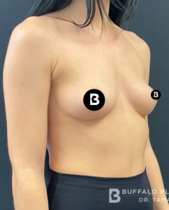 Breast Augmentation Before and After Pictures in Buffalo, NY