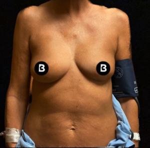 Breast Augmentation Before and After Pictures in Buffalo, NY