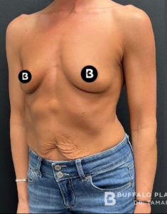 Breast Augmentation Before and After Pictures in Buffalo, NY