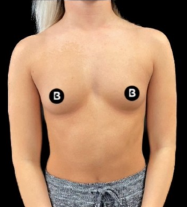 Breast Augmentation Before and After Pictures in Buffalo, NY