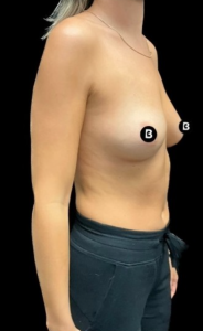 Breast Augmentation Before and After Pictures in Buffalo, NY