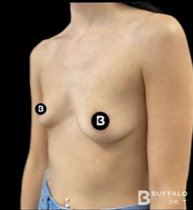 Breast Augmentation Before and After Pictures in Buffalo, NY
