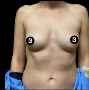 Breast Augmentation Before and After Pictures in Buffalo, NY