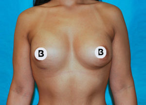 Breast Augmentation Before and After Pictures Buffalo, NY