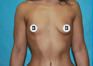 Breast Augmentation Before and After Pictures Buffalo, NY