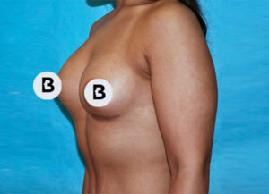 Breast Augmentation Before and After Pictures Buffalo, NY