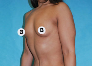 Breast Augmentation Before and After Pictures Buffalo, NY