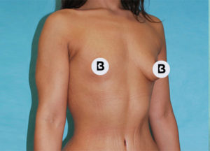 Breast Augmentation Before and After Pictures Buffalo, NY