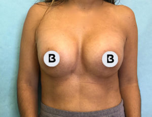 Breast Augmentation Before and After Pictures Buffalo, NY