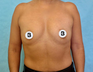 Breast Augmentation Before and After Pictures Buffalo, NY