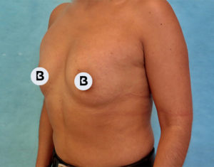 Breast Augmentation Before and After Pictures Buffalo, NY
