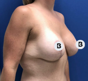 Breast Augmentation Before and After Pictures Buffalo, NY