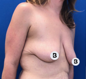 Breast Augmentation Before and After Pictures Buffalo, NY