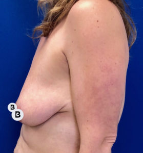Breast Augmentation Before and After Pictures Buffalo, NY