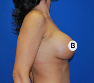 Breast Augmentation Before and After Pictures Buffalo, NY
