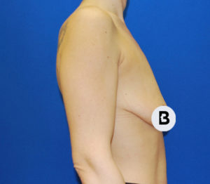 Breast Augmentation Before and After Pictures Buffalo, NY