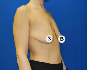 Breast Augmentation Before and After Pictures Buffalo, NY