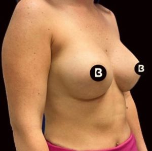 Breast Augmentation Before and After Pictures in Buffalo, NY