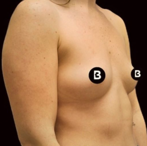 Breast Augmentation Before and After Pictures in Buffalo, NY