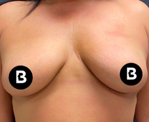 Breast Augmentation Before and After Pictures in Buffalo, NY