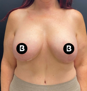 Mastopexy (Breast Lift) Before and After Pictures in Buffalo, NY
