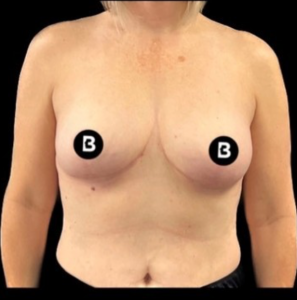 Mastopexy (Breast Lift) Before and After Pictures in Buffalo, NY