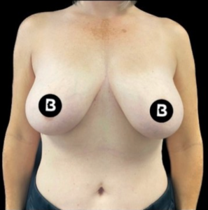 Mastopexy (Breast Lift) Before and After Pictures in Buffalo, NY