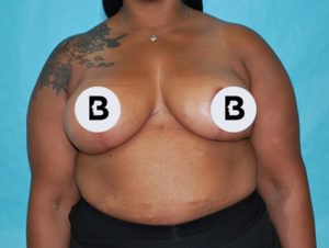 Mastopexy (Breast Lift) Before and After Pictures Buffalo, NY