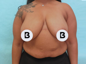 Mastopexy (Breast Lift) Before and After Pictures Buffalo, NY
