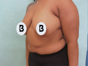 Mastopexy (Breast Lift) Before and After Pictures Buffalo, NY