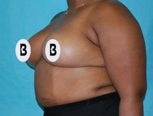 Mastopexy (Breast Lift) Before and After Pictures Buffalo, NY