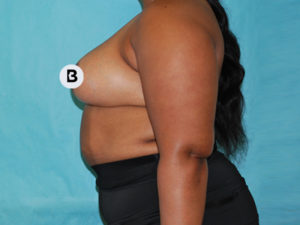 Mastopexy (Breast Lift) Before and After Pictures Buffalo, NY