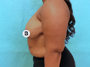 Mastopexy (Breast Lift) Before and After Pictures Buffalo, NY