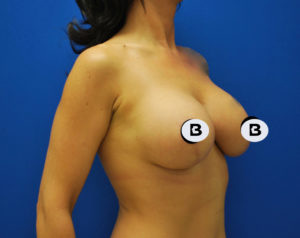 Mastopexy (Breast Lift) Before and After Pictures Buffalo, NY